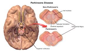 Parkinson's disease 1